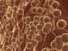 Hepatitis