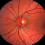 Rogue cells are eating our eyes