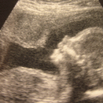 Baby’s genome sequenced before birth