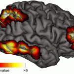 Lucid dreaming and the neural basis of consciousness