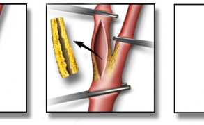 Blausen.com staff: "Medical gallery of Blausen Medical 2014
